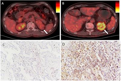 Relationship between standardized uptake value on 18F-FDG PET and PD-L1 expression in clear cell renal cell carcinoma